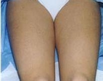 Ноги после лазерной эпиляции