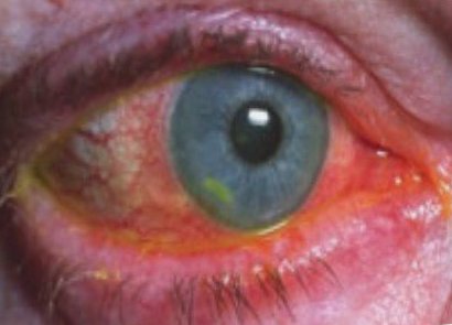 воспаление глаза