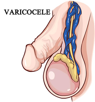 Операция варикоцеле или лечение варикоцеле без операции
