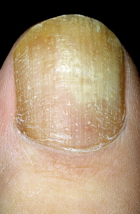 Исследование ногтей на патогенные грибки