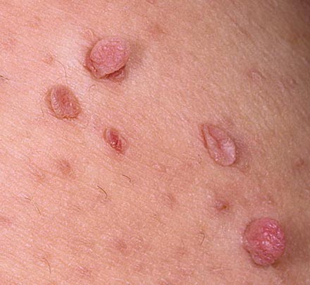 Вирусные заболевания кожи