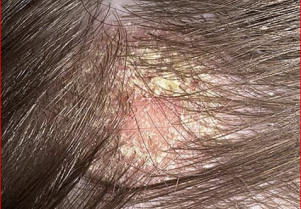 Себорея волосистой части головы. Асбестовидный лихен